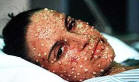Smallpox victim